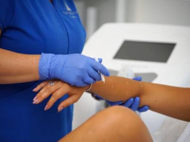 lézeres szőrtelenítés (1)